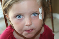 Little girl with butterfly stitches her left eye, before Daxton's adoption