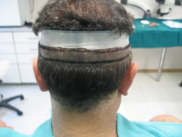 FUE Hair Transplant