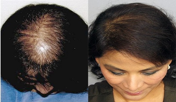 Female Hair Transplant