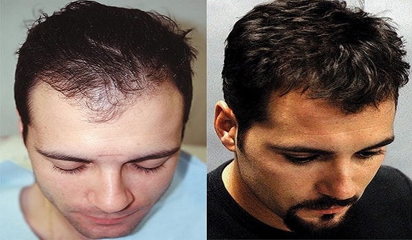 Long Term Outlook of Hair Transplant