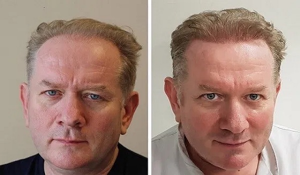 Receding Hairline Hair Transplant NJ