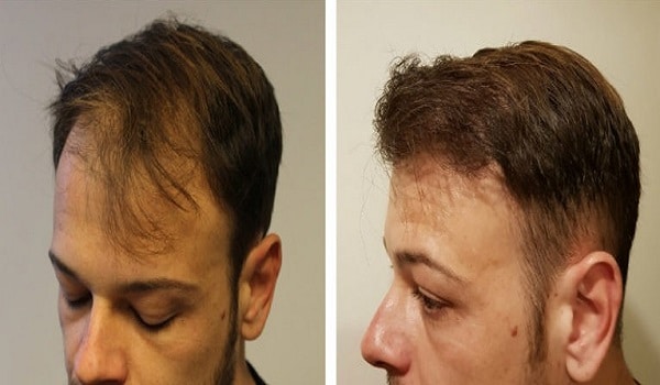 Hair Transplant Atlanta