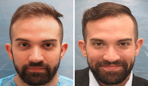 Hair Transplant Results Review New York