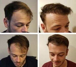 Hair Transplant Success Rate