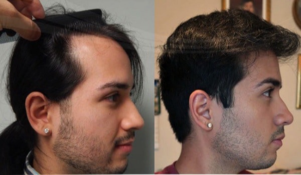 Natural Hair Transplant Results Review