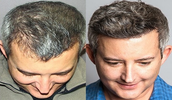 How Successful Is Hair Transplant