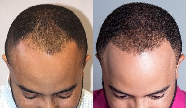 Hair Transplant Recovery