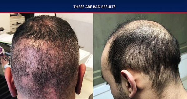 Hair Transplant Side Effects