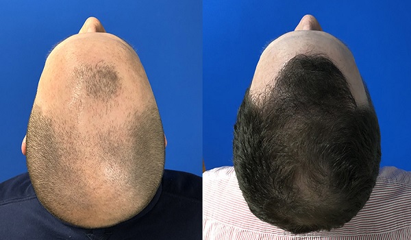 Whole Crown Hair Transplant Permanent