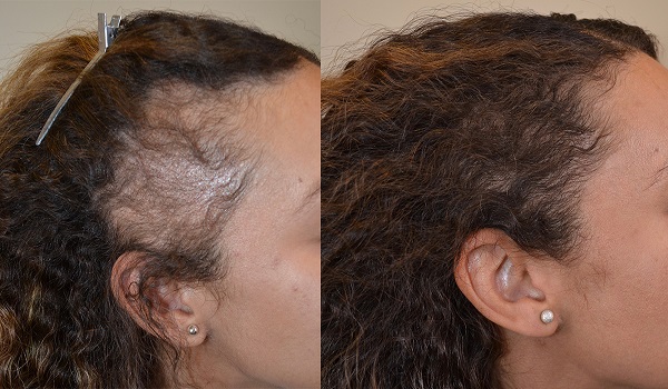 Sides Hair Transplant Results