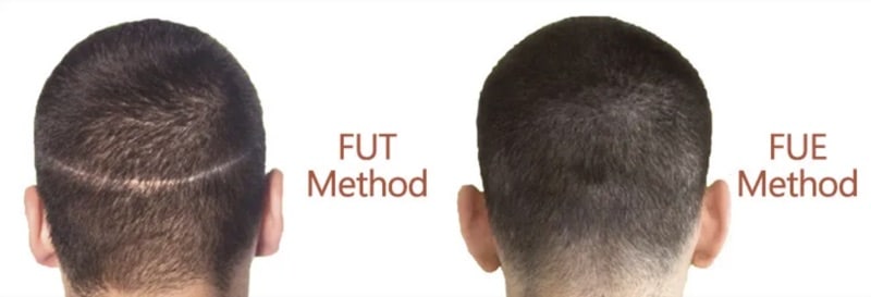 fut method fue method hair transplant