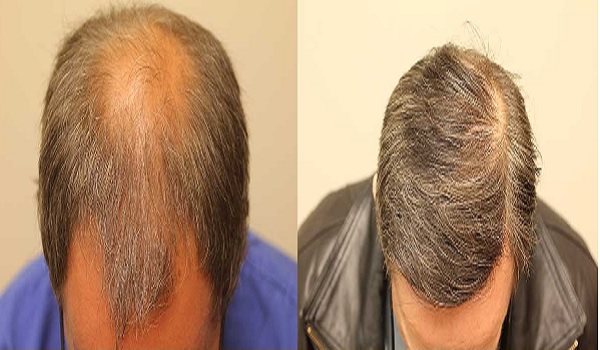 Crown Hair Transplant Success Rate