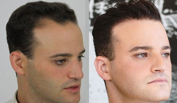 Temple Hair Transplant Cost