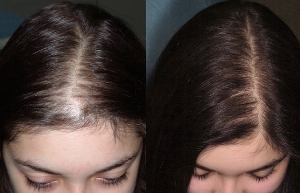 Hair Transplant for Women