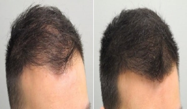 Hair Transplant Tourism India