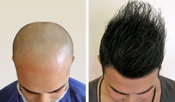 Whole Scalp Hair Transplant Procedure