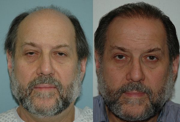 Hair Transplant Before and After