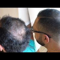 Hairstyles For Crown Balding Men